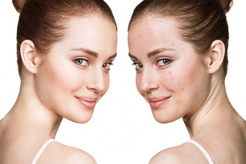 Anti-acne treatment for problematic skin